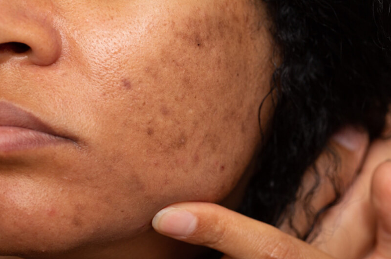 Hyperpigmentation    