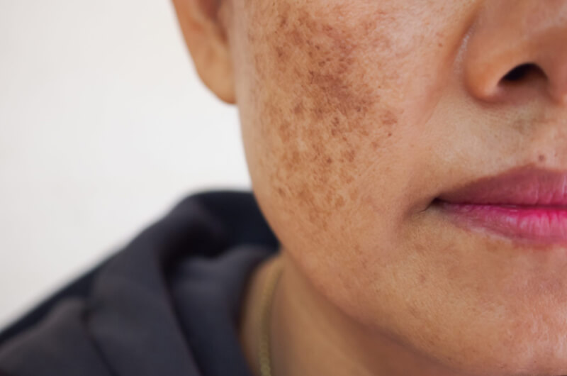 Hyperpigmentation    