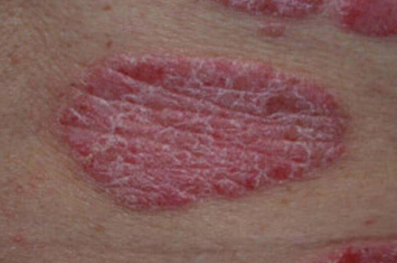 Psoriasis  