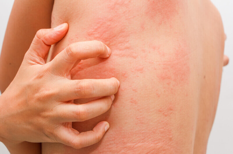 Urticaria Treatment in gurugram