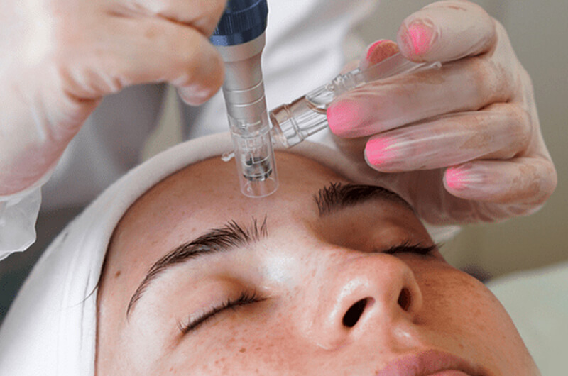 Microneedling in gurugram